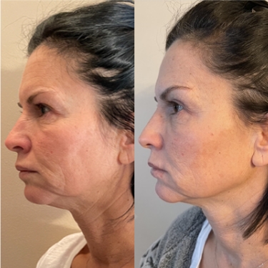 NB-Before-After 375×375 ÔÇô 1