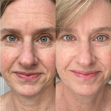 NB-Before-After 375×375 ÔÇô 2